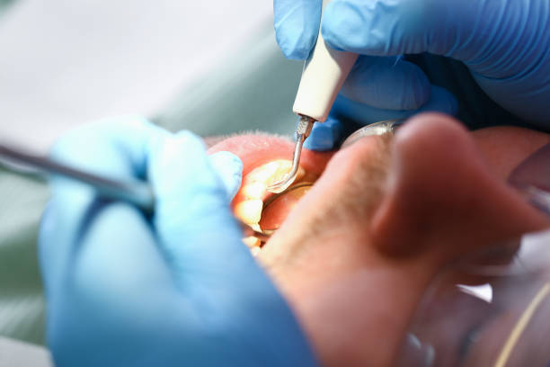 Best Emergency Tooth Extraction in Palestine, TX